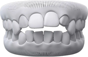 invisalign Teeth